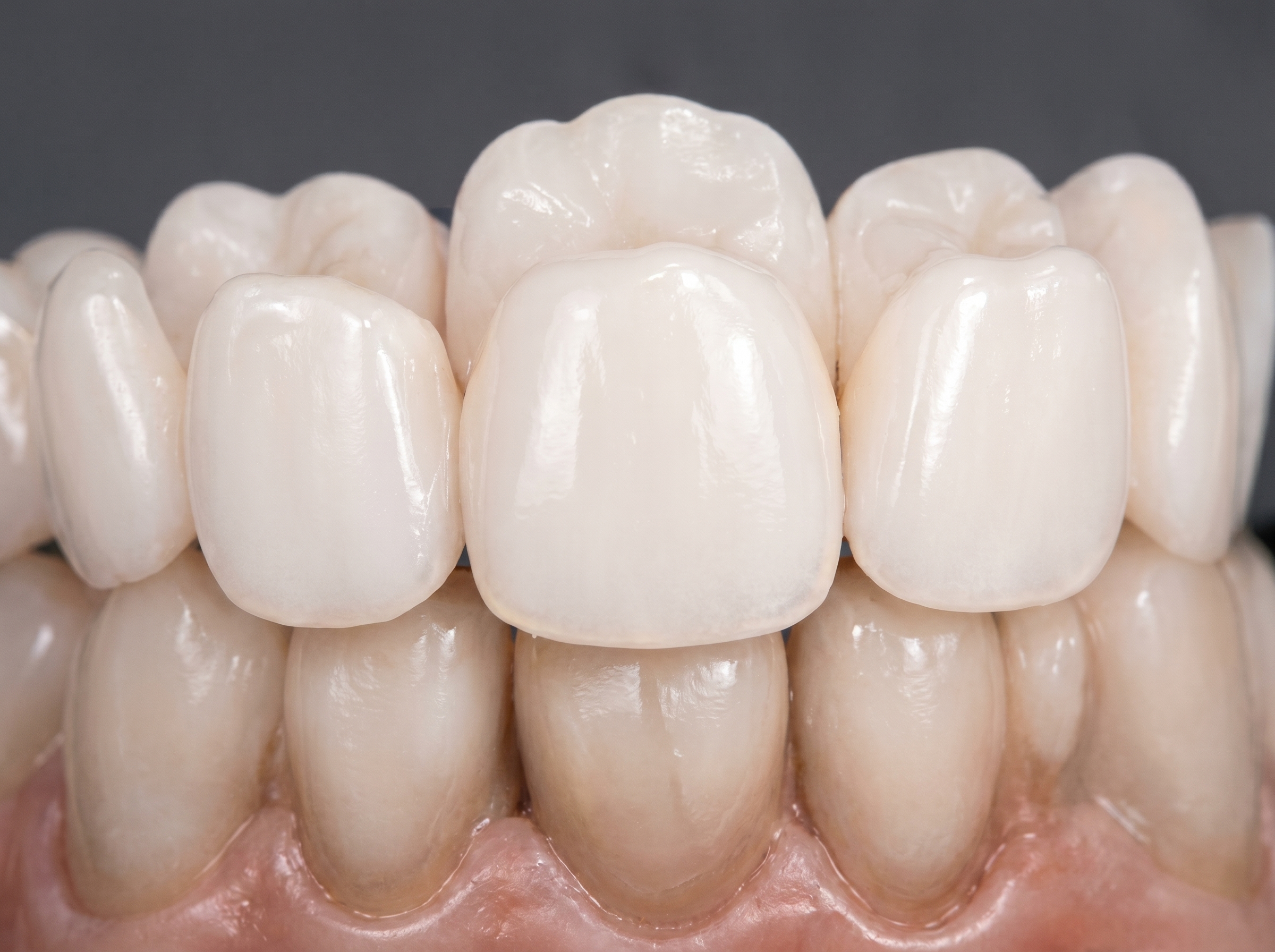 Zirconium Crowns