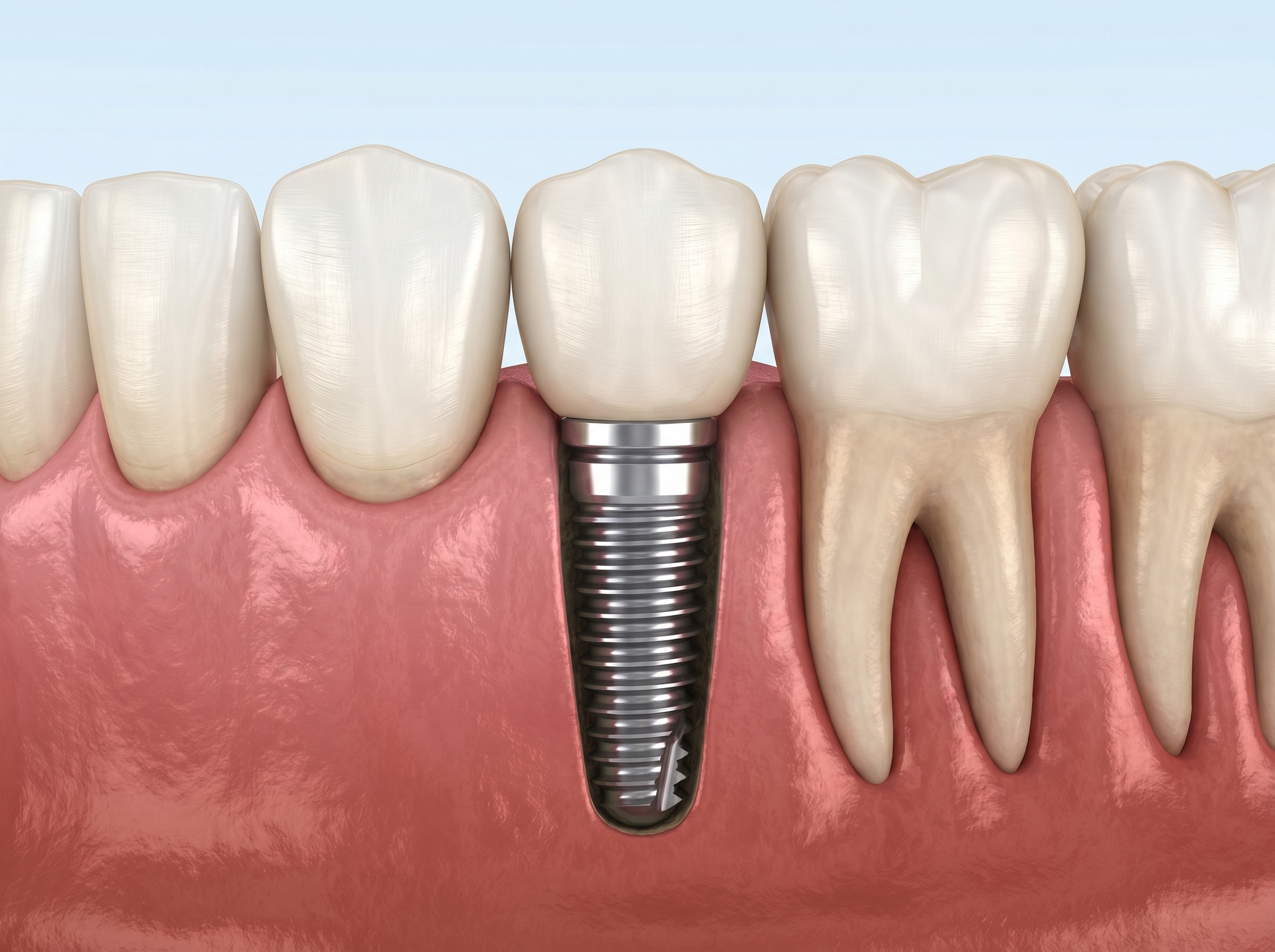 Dental Implants